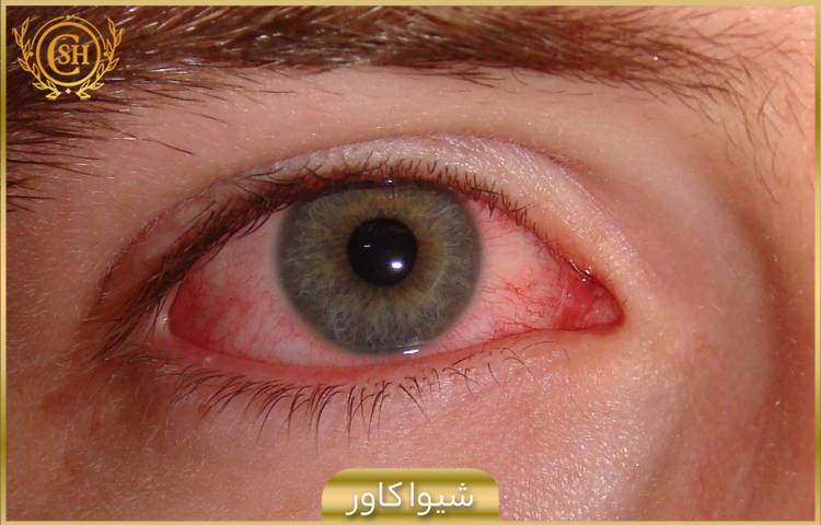 التهاب و قرمزی چشم ها بر اثر ورود جسم خارجی