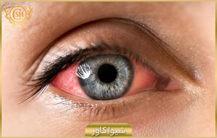 التهاب و قرمزی چشم ها در اثر اختلال عملکرد پلک ها
