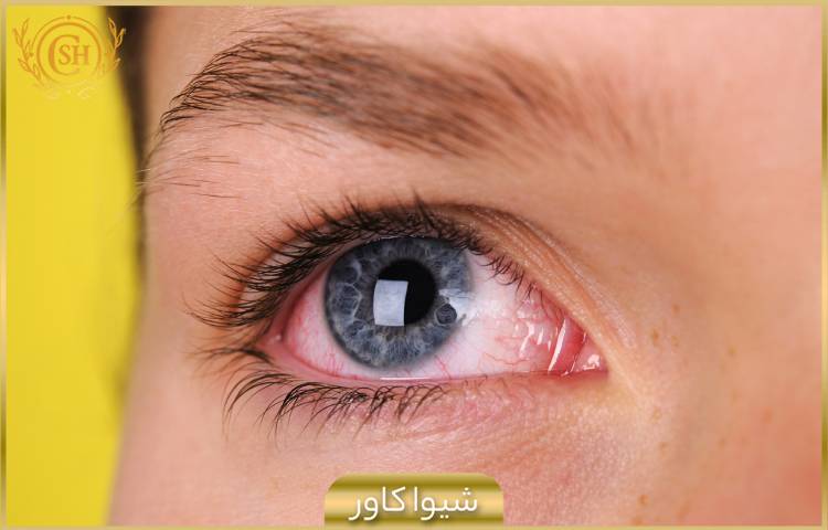 علت های التهاب و قرمزی چشم