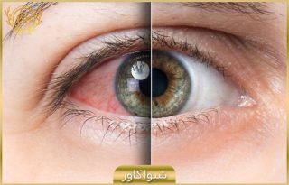 راه های درمان خشکی چشم