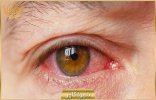 علل ایجاد خشکی چشم