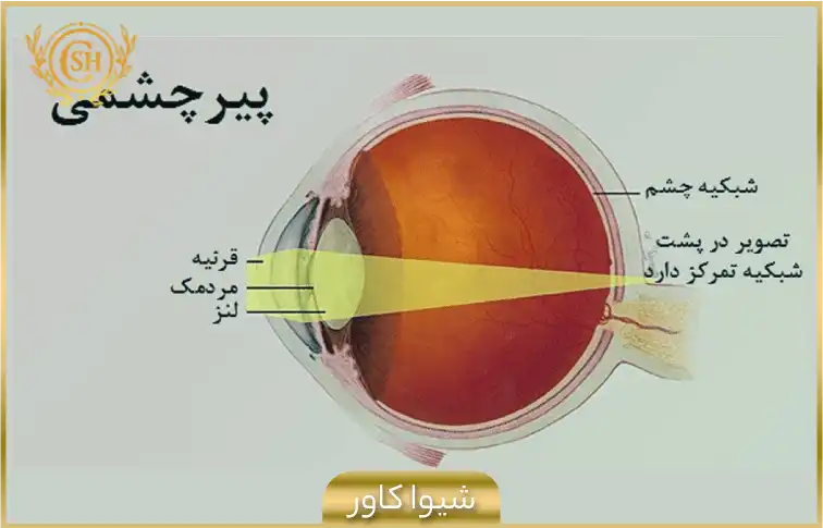 علت پیر چشمی چیست؟
